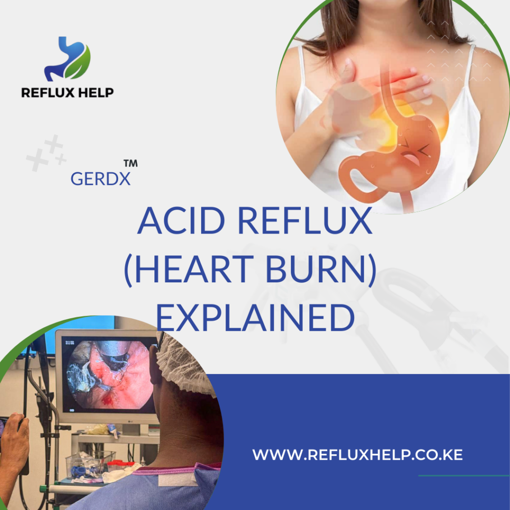 ACID REFLUX